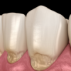 Tooth sensitivity resulting from