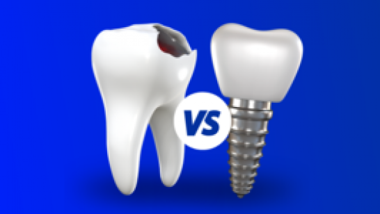 รักษารากฟัน vs รากฟันเทียม ความแตกต่างที่ควรรู้!