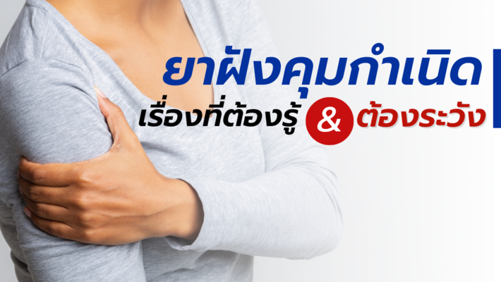 ยาฝังคุมกำเนิด? เรื่องที่ควรรู้&ต้องระวัง