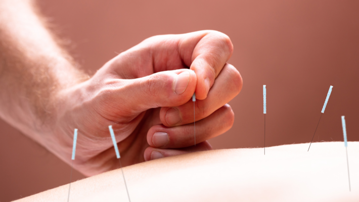 Acupuncture : Traditional Chinese Medicine for Healing and Treatment