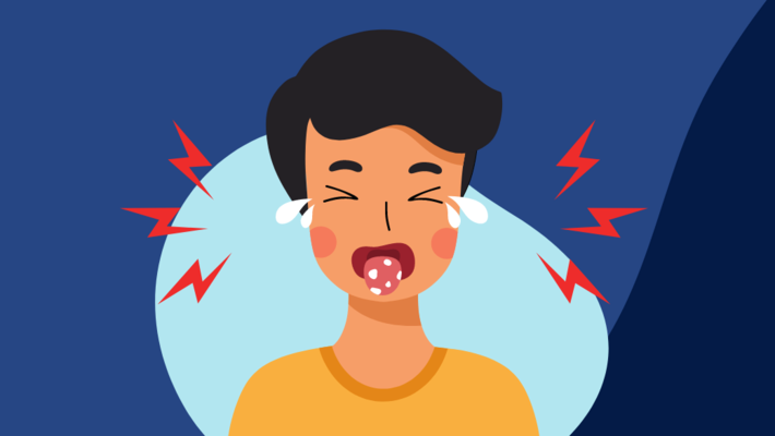 “Canker sores” a fussy problem that can be treated by yourself.