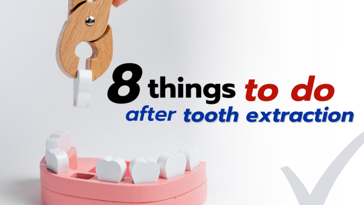 8 things to do after “tooth extraction”