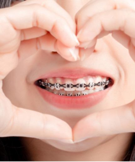 Dental Braces Promotion 2023