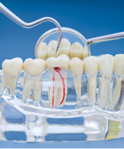 Root Canal Treatment