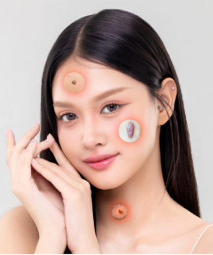 Surgical Removal Program: Keloids / Moles / Skin Tags