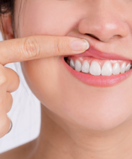 Gum Laser Treatment to Address Black Gums